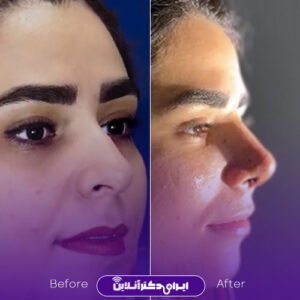 نمونه کار دکتر حمیدرضا نقدی جراح بینی مشهد