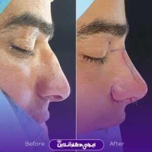 نمونه کار عمل بینی دکتر سبحان پور شیراز