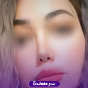 نمونه کار دکتر عباس رنگین جراح بینی در مشهد