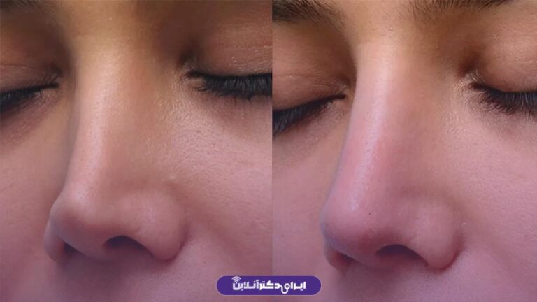 بینی کلیپسی چیست | ویژگی ها + عوارض دماغ کلیپسی