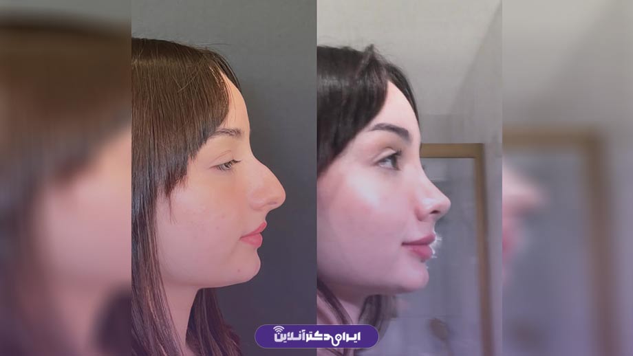 جراحی بینی کلیپسی چیست؟ (ویژگی های دماغ کلیپسی) 8 مزایا و معایب جراحی بینی کلیپسی