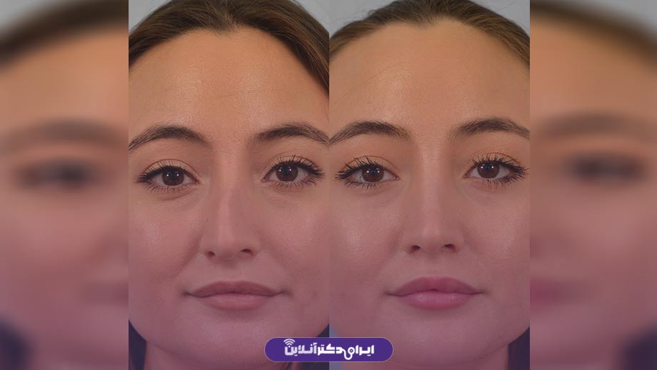 جراحی بینی کلیپسی چیست؟ (ویژگی های دماغ کلیپسی) 9 عوارض احتمالی عمل بینی کلیپسی