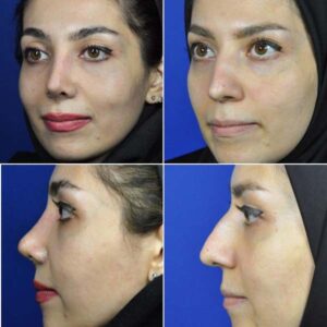 نمونه کار جراحی و عمل بینی مشهد دکتر مهدی رمضانی اول