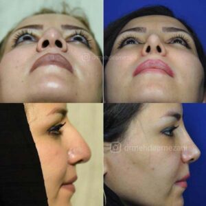 دکتر مهدی رمضانی اول، نمونه جراحی بینی مشهد