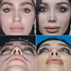 نمونه جراحی بینی دکتر مهدی رمضانی اول