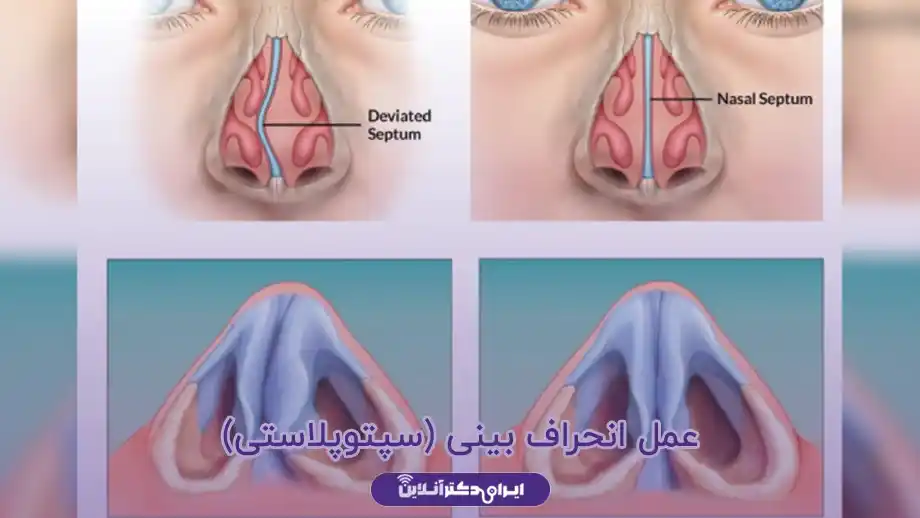 عمل انحراف بینی چیست