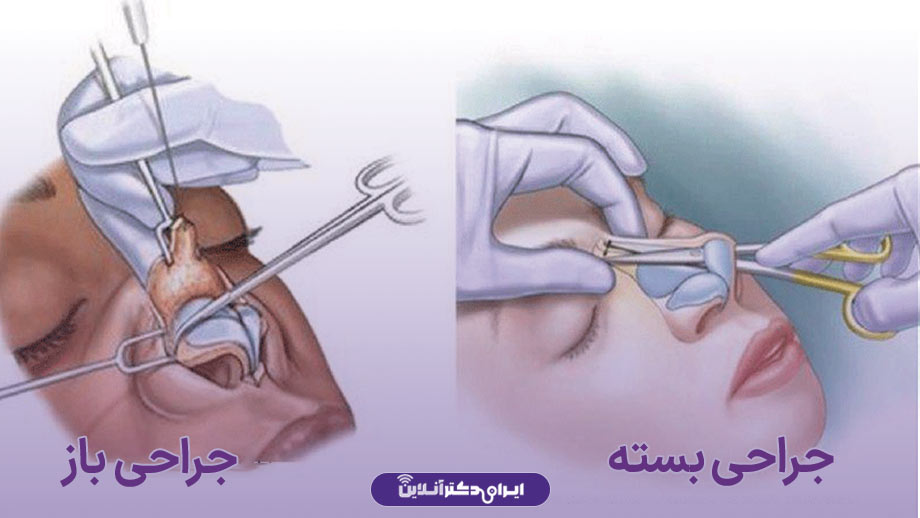 مهمترین تفاوت عمل باز و بسته بینی چیست؟ 2 نحوه عمل، فرق جراحی بسته و باز بینی