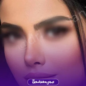 نمونه کار جراحی بینی گوشتی دکتر باباجانی در تهران 2