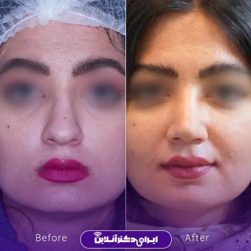 بهترین جراح بینی گوشتی در تهران + معرفی 20 پزشک برتر 78 نمونه جراحی قبل و بعد بینی گوشتی دکتر فرزاد نیکوسرشت 2