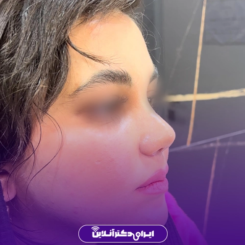 بهترین جراح بینی گوشتی در تهران + معرفی 20 پزشک برتر 46 نمونه کار عمل بینی گوشتی دکتر کامبیز ایزدپناه 1