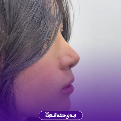 بهترین جراح بینی گوشتی در تهران + معرفی 20 پزشک برتر 45 نمونه کار عمل بینی گوشتی دکتر کامبیز ایزدپناه 2