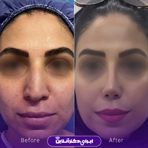 بهترین جراح بینی گوشتی در تهران + معرفی 20 پزشک برتر 49 نمونه کار عمل بینی گوشتی دکتر خسرو مقتدر 2