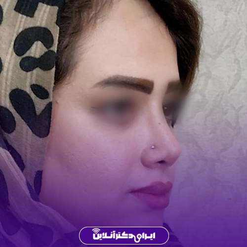 بهترین جراح بینی گوشتی در تهران + معرفی 20 پزشک برتر 61 نمونه کار قبل و بعد عمل بینی گوشتی دکتر سید علی عقیلی 2