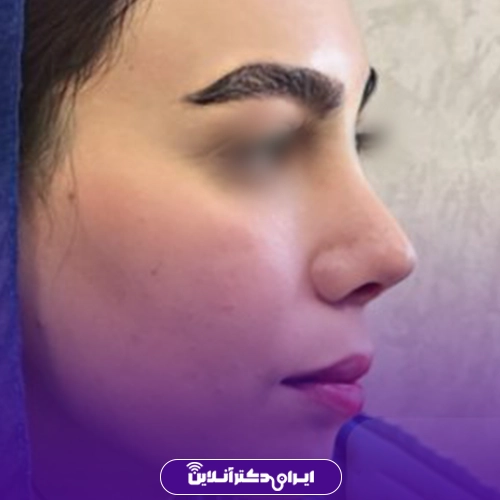 بهترین جراح بینی گوشتی در تهران + معرفی 20 پزشک برتر 60 نمونه کار قبل و بعد عمل بینی گوشتی دکتر سید علی عقیلی 1