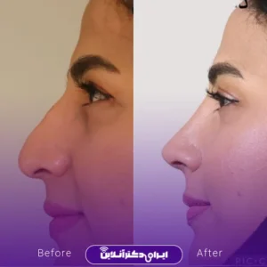 نمونه کار عمل بینی دکتر افشین باقری 5