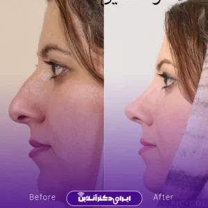 نمونه کار عمل بینی دکتر افشین باقری 7