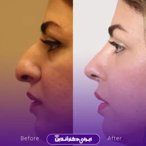 نمونه کار عمل بینی دکتر افشین باقری 8