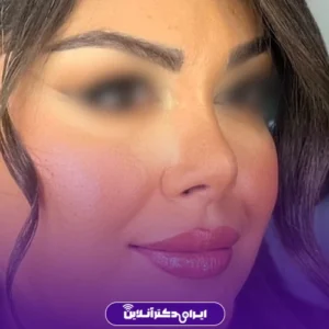نمونه کار عمل بینی دکتر علی فقیه حبیبی 3