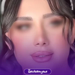 نمونه کار عمل بینی دکتر علی فقیه حبیبی 4