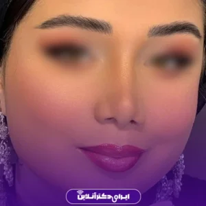 نمونه کار عمل بینی دکتر علی فقیه حبیبی 5