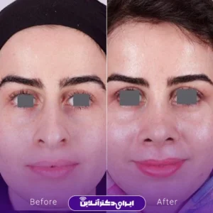 نمونه کار عمل بینی دکتر علی فقیه حبیبی 7