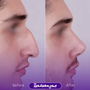 نمونه کار عمل بینی دکتر علی فقیه حبیبی 8