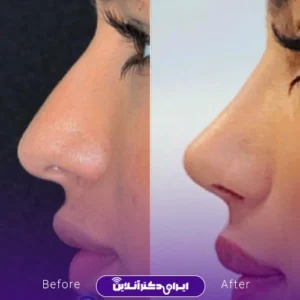 نمونه کار عمل بینی دکتر امین نوروزی 1