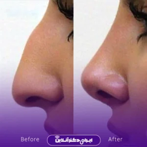 نمونه کار عمل بینی دکتر امین نوروزی 5