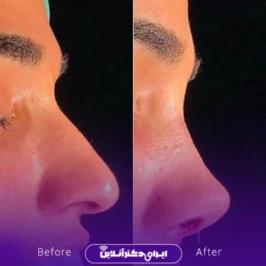 نمونه کار عمل بینی دکتر امین نوروزی 7