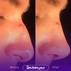 نمونه کار عمل بینی دکتر امین نوروزی 8