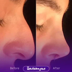 نمونه کار عمل بینی دکتر امین نوروزی 9