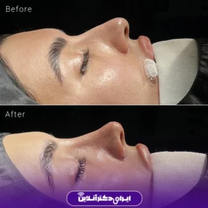 نمونه کار عمل بینی دکتر امیرحسین سروری 1