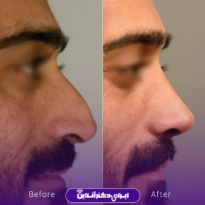 نمونه کار عمل بینی دکتر امیرحسین سروری 4