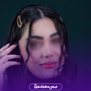 نمونه کار عمل بینی دکتر آرش نجف بیگی 2