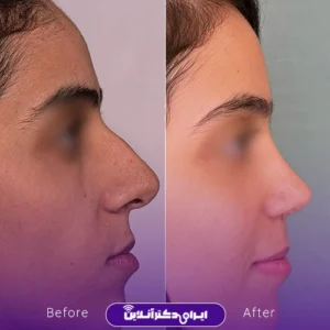 نمونه کار عمل بینی دکتر بهنام خرمی 10
