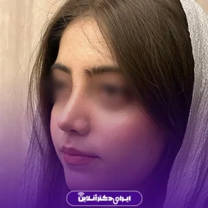 نمونه کار عمل بینی دکتر بهنام خرمی 2