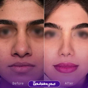 نمونه کار عمل بینی دکتر بهنام خرمی 5