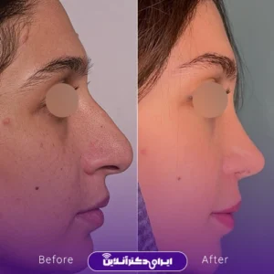 نمونه کار عمل بینی دکتر بهنام خرمی 6