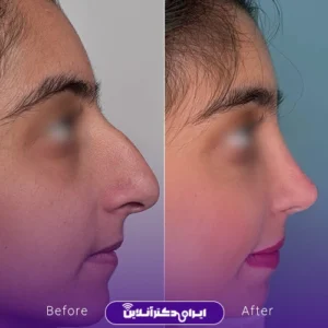 نمونه کار عمل بینی دکتر بهنام خرمی 7