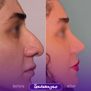 نمونه کار عمل بینی دکتر بهنام خرمی 8