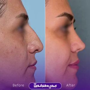 نمونه کار عمل بینی دکتر بهنام خرمی 9