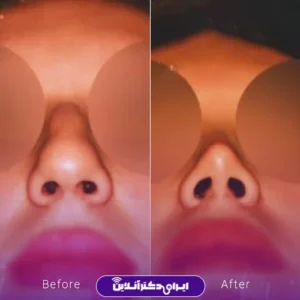 نمونه کار عمل بینی دکتر بیژن ربیعی 1