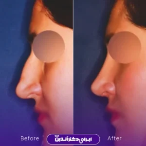 نمونه کار عمل بینی دکتر بیژن ربیعی 10