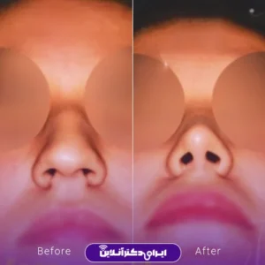 نمونه کار عمل بینی دکتر بیژن ربیعی 2