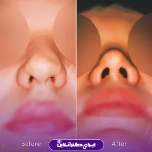 نمونه کار عمل بینی دکتر بیژن ربیعی 4