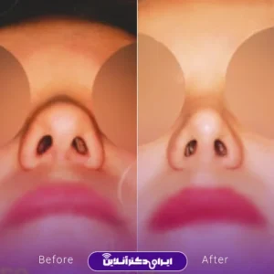 نمونه کار عمل بینی دکتر بیژن ربیعی 5