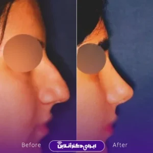 نمونه کار عمل بینی دکتر بیژن ربیعی 6