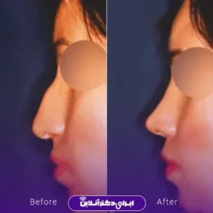 نمونه کار عمل بینی دکتر بیژن ربیعی 7