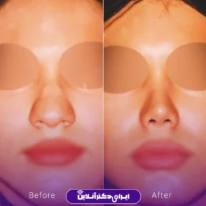 نمونه کار عمل بینی دکتر بیژن ربیعی 8
