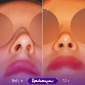 نمونه کار عمل بینی دکتر بیژن ربیعی 9